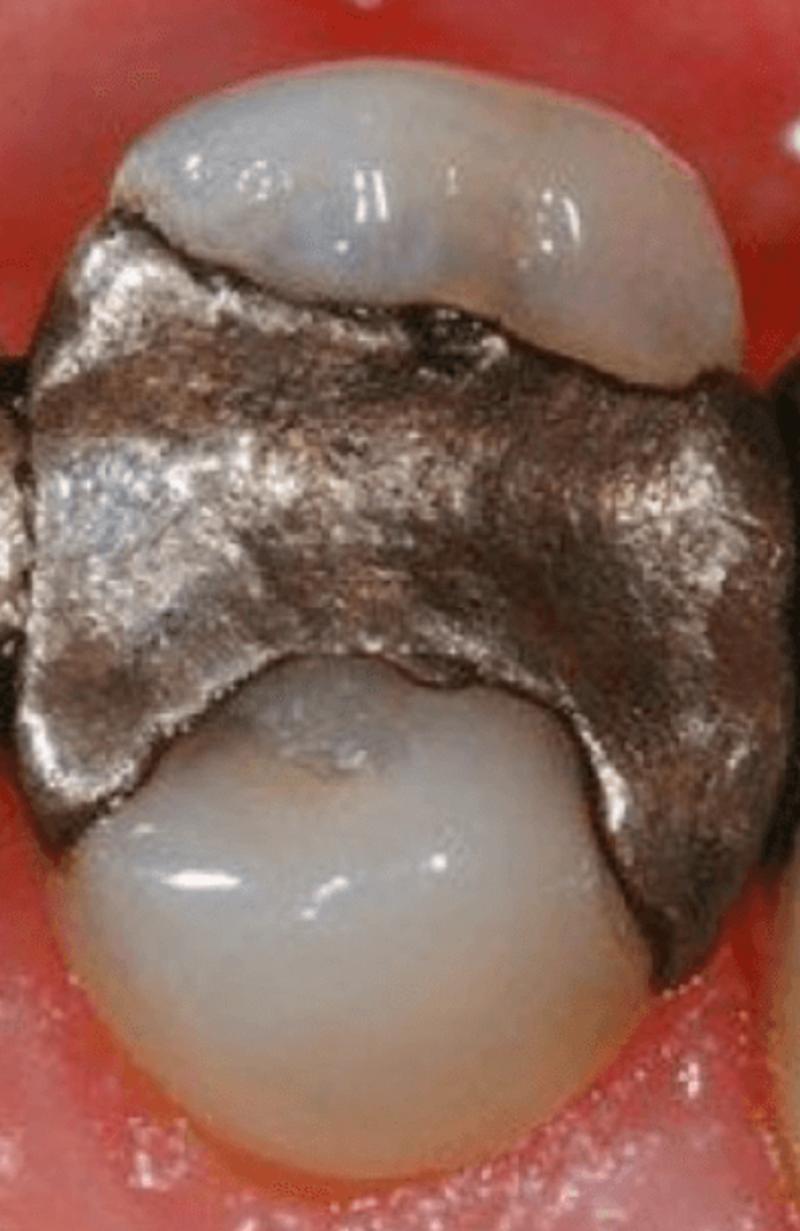 First description of amalgam to restore teeth